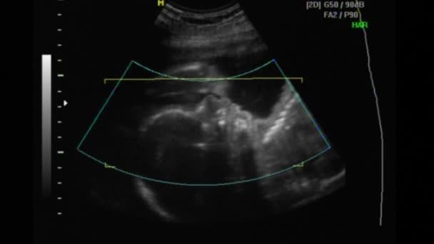 2D- und 3D-Ultraschall eines schönen Babys in der 23. Schwangerschaftswoche — Stockvideo