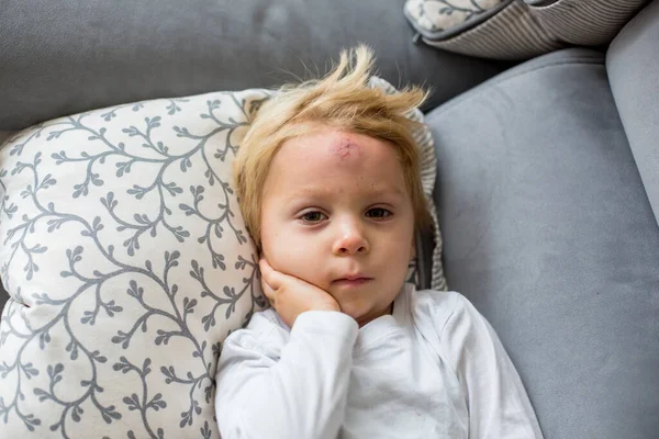 Småbarn Pojke Liggande Soffan Hemma Med Stor Bula Pannan Efter — Stockfoto