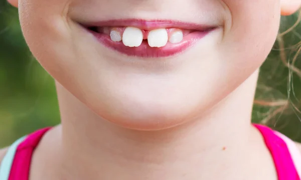 Morsure Incorrecte Chez Enfant Malocclusion Chez Les Enfants Photo De Stock