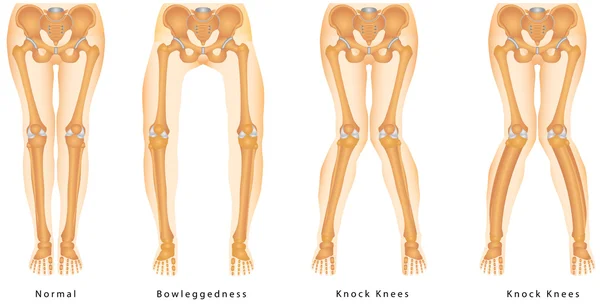 Des bandy-jambes. Forme des jambes — Image vectorielle