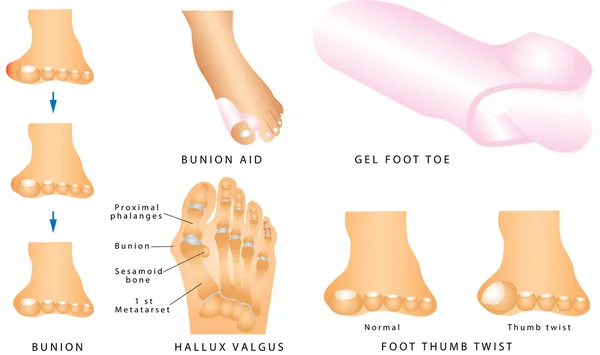 Bunion. Foot with a painful bunion — Stock Vector