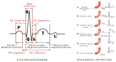 Kalp döngüsü. ECG normal. Miyokardiyal enfarktüs. EKG. Miyokardiyal hasarın evrimi sırasında dalga değişiklikleri. Arka duvarda miyokardiyal enfarktüs ve çevresel arterin tıkanması..