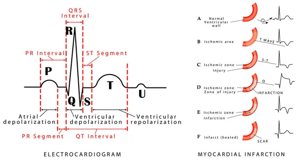 心臓の周期だ 通常のEcg 心筋梗塞 Ecg 心筋損傷の進化中の波の変化 後壁の心筋梗塞とサークルフレックス動脈の閉塞 — ストックベクタ