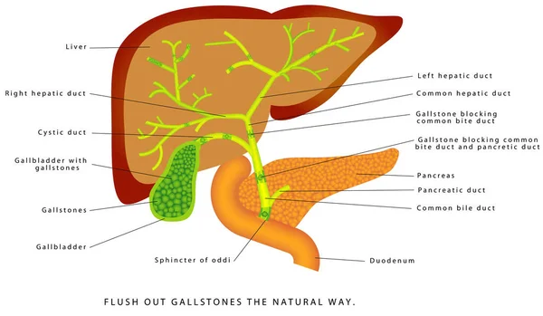 Galstenen Galblaas Menselijke Lever Galblaas Anatomie Galstenen Natuurlijke Manier Uitspoelen — Stockvector