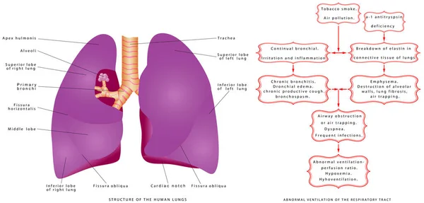 Disturbi Del Tratto Respiratorio Respirazione Salute Superiore Sinusite Otite Media — Vettoriale Stock