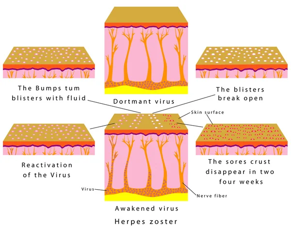 Herpes zoster. — Vetor de Stock