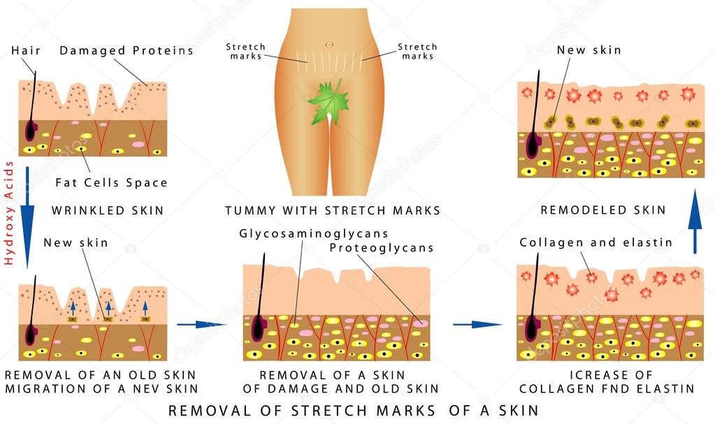 Stretch Marks of a skin
