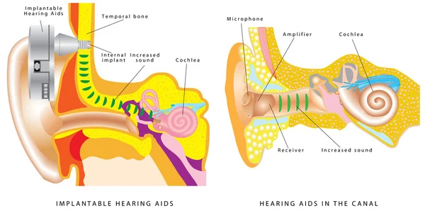 Ear hearing aid. — Stock Vector