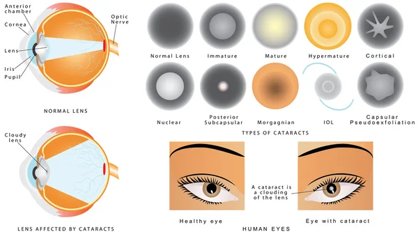 Cataract — Stock Vector