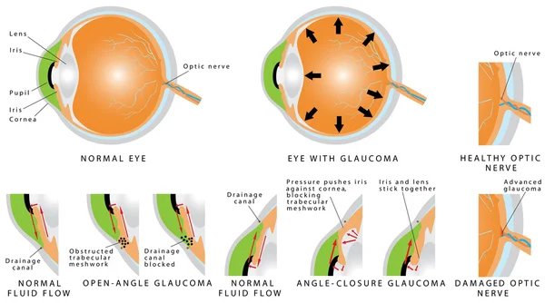 Glaucoma — Vettoriale Stock