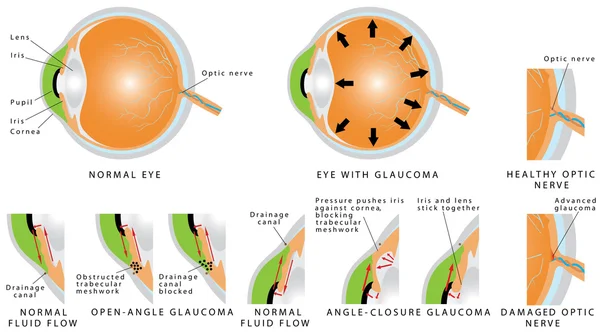 Glaucomajovem mulher escová-la — Vetor de Stock