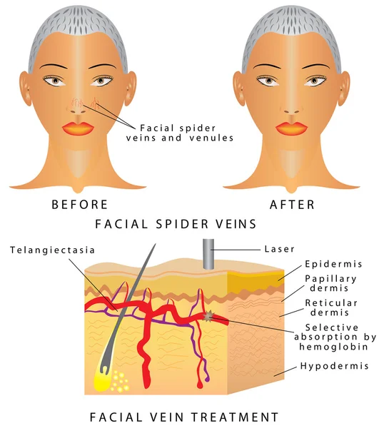 Venas en la cara — Vector de stock