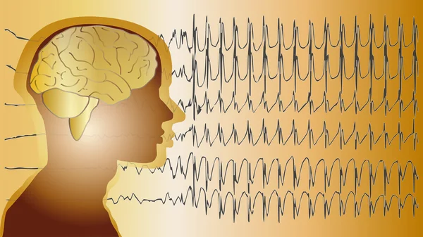 Orvosi háttér agy epilepszia — Stock Fotó