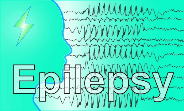 뇌 뇌 파 의료 Epilepsie — 스톡 사진