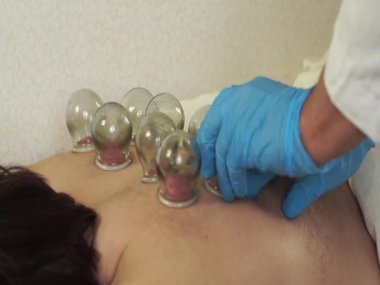 Bir tıp uzmanı, hastayı tedavi etmek için cam kavanozlar kullanır. Tedavi prosedürü bitmiştir.