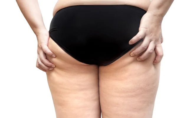 Problema de celulitis en glúteos y piernas estrías de mujer joven —  Fotos de Stock
