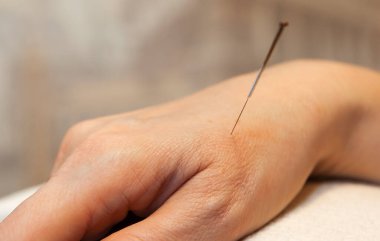 Akupunktur. He-Gu 'nun tüm hastalıklardan korunma amacı. Tarih 1 Mart 2017