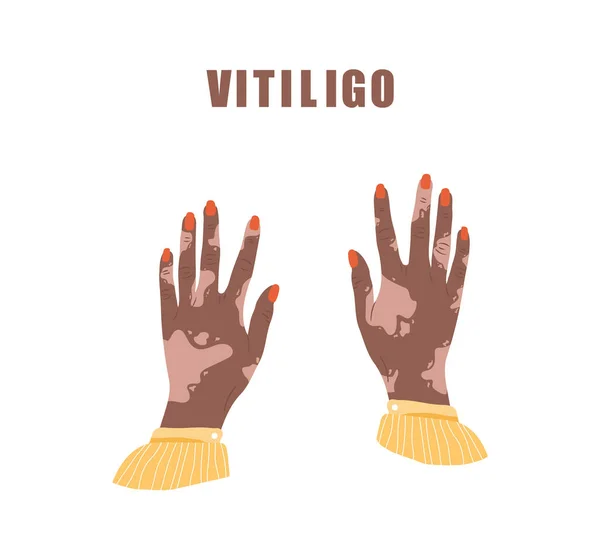 Afrikanska kvinnliga händer med vitiligo. Världsvitiligo-dagen. Hudsjukdom. Egenvård och självkärlek. Vektor illustration i platt tecknad stil — Stock vektor