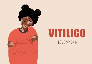 Vitiligo 'lu Afrikalı kadın. Kendine dikkat et ve kendini sev. Dünya Vitiligo Günü. Deri hastalığı. Çizgi film tarzında vektör illüstrasyonu