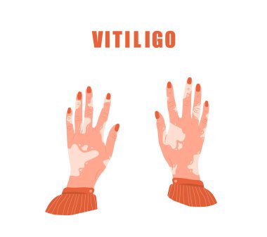 Vitiligo 'lu kadın elleri. Dünya Vitiligo Günü. Deri hastalığı. Kendine dikkat et ve kendini sev. Çizgi film tarzında vektör illüstrasyonu