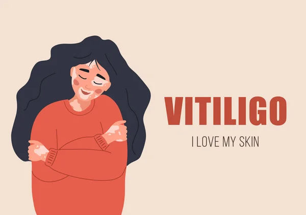 Femeie cu vitiligo. Îngrijirea de sine și iubirea de sine. Ziua mondială vitiligo. Boala de piele. Ilustrație vectorială în stil desene animate plate — Vector de stoc