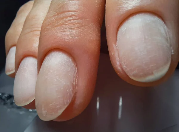 Необработанные Ногти Пальцы Маникюром Гелевого Лака Вблизи — стоковое фото