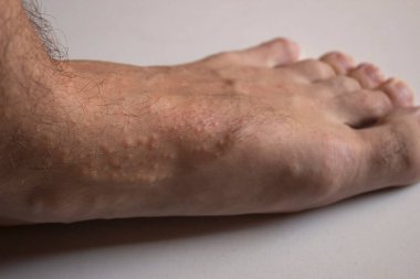 Bacağa alerjik reaksiyon. Ayağımda kızarıklık var. Dermatolojik hastalık. Bacağındaki sivilceler.