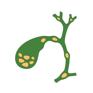 Variants of the location of stones in the gallbladder and bile ducts. Schematic drawing for cholelithiasis, gallstone disease. clipart