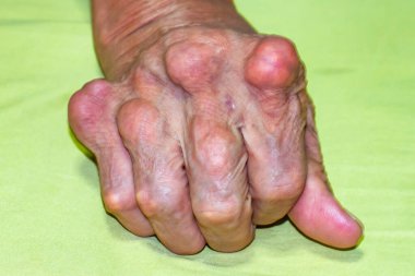 Yaşlılık ve ilaç hastalıkları eklem ağrısı, kemik ağrısı, gut, eklem iltihabı, kol, ayak, diz, romatizma semptomları, soyut acı ve umutsuzluk konsepti olan erkeklerde şiddetli gut hastalığı