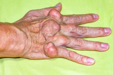Yaşlılık ve ilaç hastalıkları eklem ağrısı, kemik ağrısı, gut, eklem iltihabı, kol, ayak, diz, romatizma semptomları, soyut acı ve umutsuzluk konsepti olan erkeklerde şiddetli gut hastalığı