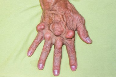 Yaşlılık ve ilaç hastalıkları eklem ağrısı, kemik ağrısı, gut, eklem iltihabı, kol, ayak, diz, romatizma semptomları, soyut acı ve umutsuzluk konsepti olan erkeklerde şiddetli gut hastalığı