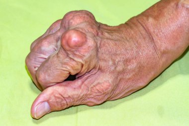 Yaşlılık ve ilaç hastalıkları eklem ağrısı, kemik ağrısı, gut, eklem iltihabı, kol, ayak, diz, romatizma semptomları, soyut acı ve umutsuzluk konsepti olan erkeklerde şiddetli gut hastalığı