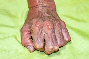 Yaşlılık ve ilaç hastalıkları eklem ağrısı, kemik ağrısı, gut, eklem iltihabı, kol, ayak, diz, romatizma semptomları, soyut acı ve umutsuzluk konsepti olan erkeklerde şiddetli gut hastalığı