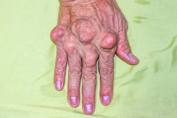 Old Age Illnesses Pharmaceutical Medicament Severe Gout Men Suffering Joint — Stock Photo, Image