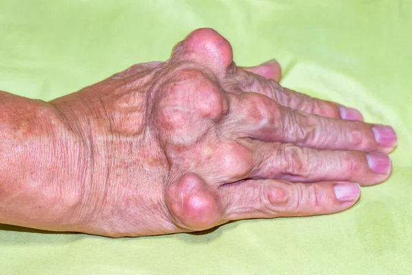 Starość Choroby Farmaceutyczne Leki Ciężka Dny Moczanowej Mężczyzn Cierpiących Ból — Zdjęcie stockowe