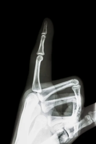 Film x-ray index finger and hand ( point a finger ) — Stock Photo, Image