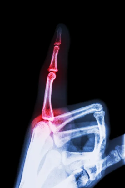 関節リウマチ、光腸関節炎(フィルムX線人差し指と手(指を指す)と指の炎症 ) — ストック写真