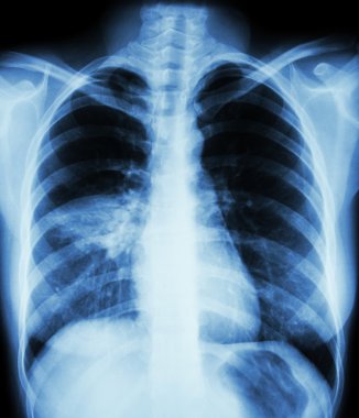 Pneumonia ( film chest x-ray show alveolar infiltrate at right middle lung ) ( image for pulmonary tuberculosis , Mers-CoV , SARS ) clipart