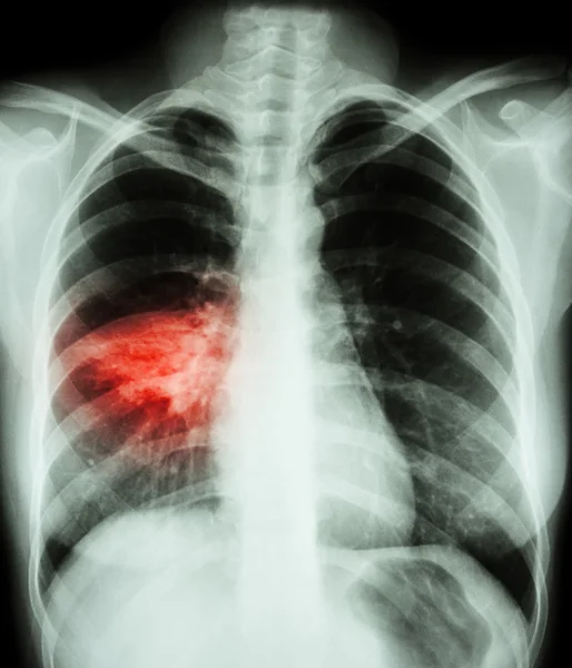 Pneumonie (film radio thoracique montrant une infiltration alvéolaire au poumon moyen droit) (image pour la tuberculose pulmonaire, Mers-CoV, SRAS  ) — Photo