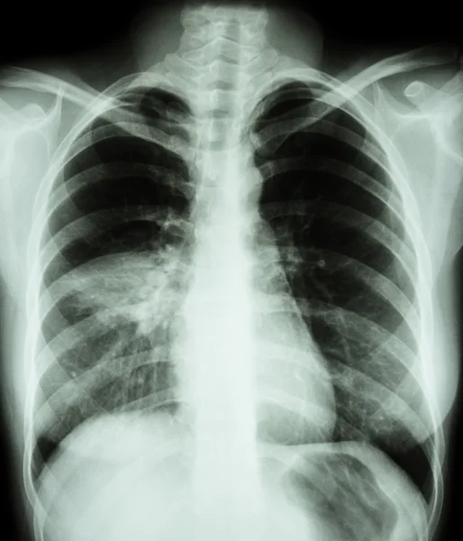 Pneumonie (film radio thoracique montrant une infiltration alvéolaire au poumon moyen droit) (image pour la tuberculose pulmonaire, Mers-CoV, SRAS  ) — Photo