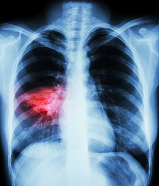 Neumonía (radiografía de tórax que muestra infiltrado alveolar en el pulmón medio derecho) (imagen para tuberculosis pulmonar, Mers-CoV, SARS  ) —  Fotos de Stock