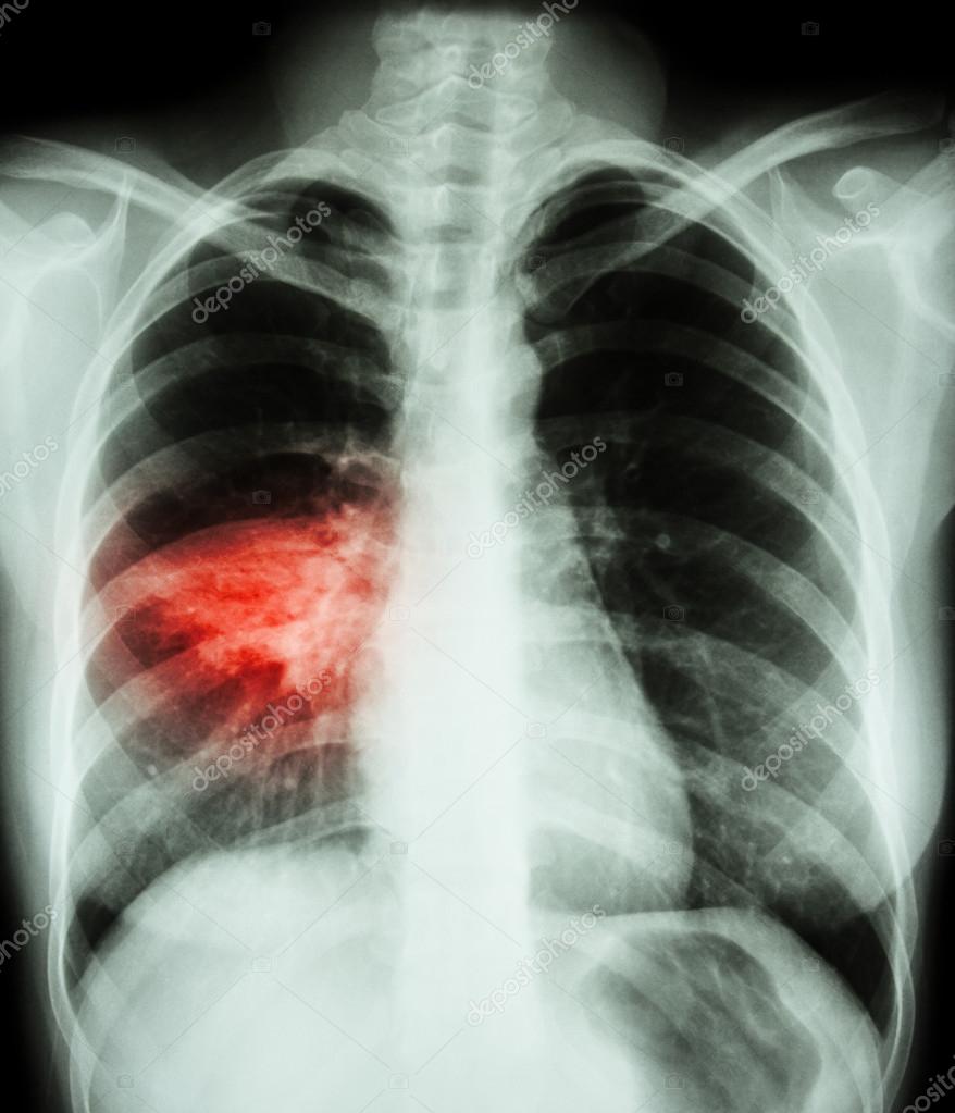 Pneumonia Film Chest X ray Show Alveolar Infiltrate At Right Middle pneumonia-film-chest-x-ray-show-alveolar-infiltrate-at-right-middle