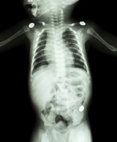 Film X-ray whole body of infant — Stock Photo, Image