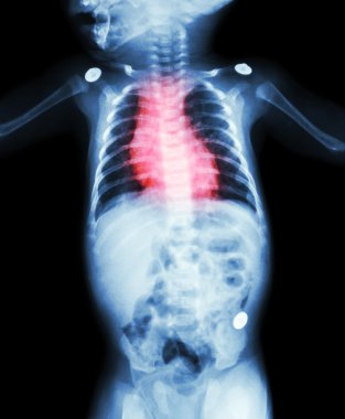 Konjenital Kalp Hastalığı , Romatizmal Kalp Hastalığı ( Kalp bölgesinde çocuk ve kırmızı renk x-Ray vücut )