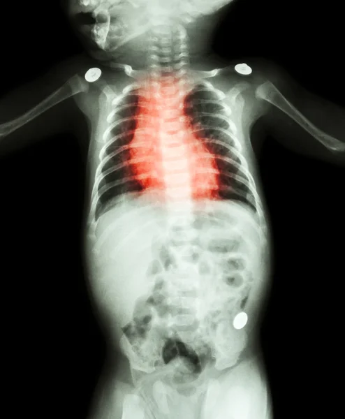 Cardiopatía congénita, cardiopatía reumática (radiografía de todo el cuerpo del niño y color rojo en el área del corazón  ) — Foto de Stock