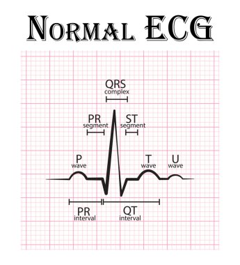 Normal Ekg ( Elektrokardiyogram ) ( P dalgası , Pr segment , Pr aralığı , Qrs kompleksi , Qt aralığı , St segment , T dalgası , U dalgası )