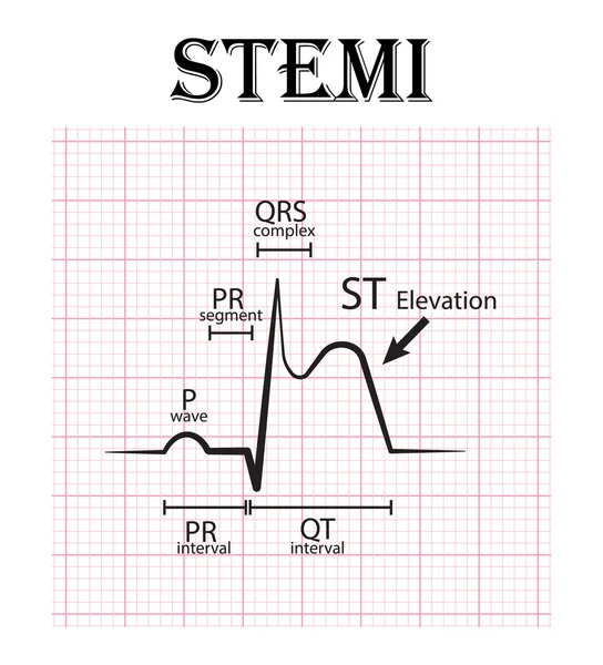 ECG de infarto do miocárdio com supradesnivelamento do segmento ST (IAMCSST) e detalhe do ECG (onda P, segmento PR, intervalo PR, complexo QRS, intervalo QT, elevação do segmento ST, onda T) Síndrome coronariana aguda, angina de peito — Vetor de Stock