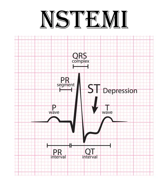 Ecg des Myokardinfarkts (nstemi) und Detail der Ecg (p-Welle, pr-Segment, pr-Intervall, qrs-Komplex, qt-Intervall, st-depress, t-Welle) akutes Koronarsyndrom, Angina pectoris — Stockvektor