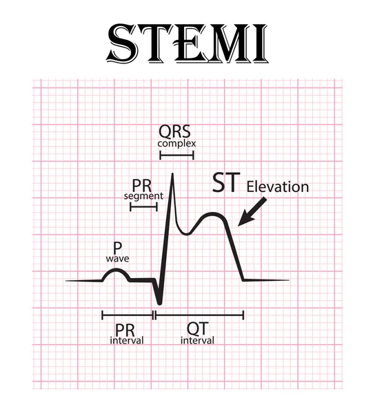 EKG z St elewacji zawał mięśnia sercowego (Stemi) i powiększenie EKG (fali P, segmentu Pr, odstępu Pr, kompleks zespołu Qrs, odstęp Qt, St podnieść, załamka T) ostre zespoły wieńcowe, dławica piersiowa — Wektor stockowy