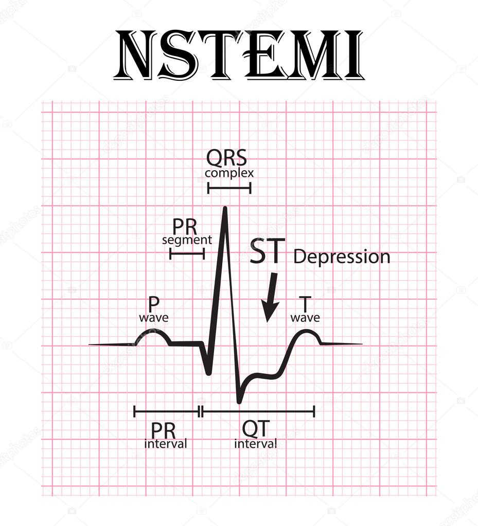 ecg of non st elevation myocardial infarction nstemi and p wave ecg